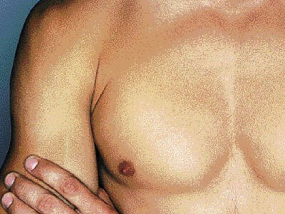 Τα υψηλά επίπεδα προλακτίνης σε ασθενείς με στυτική δυσλειτουργία μειώνουν τον κίνδυνο εμφάνισης καρδιαγγειακού επεισοδίου