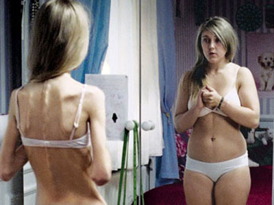 Νευρική ανορεξία αλλά και ερωτική ανορεξία