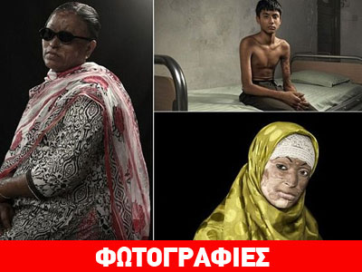 Τα πρόσωπα του θάρρους: Όσοι επέζησαν από επιθέσεις με οξύ