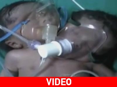 Μωρό με δύο κεφάλια σε ένα σώμα γεννήθηκε στην Ινδία