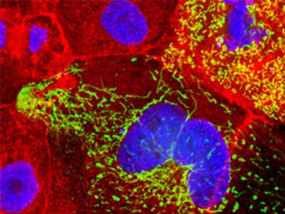 Διάγνωση Αλτσχάιμερ με απλή εξέταση αίματος