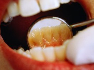 Μυστικά για αστραφτερή οδοντοστοιχία