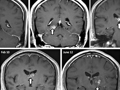 Ζούσε επί τέσσερα έτη με ένα σκουλήκι στον εγκέφαλό του
