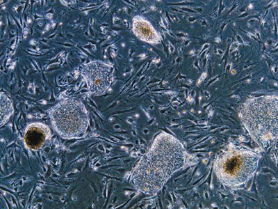 Στη μάχη για την ομορφιά τα αυτόλογα βλαστοκύτταρα Στη μάχη για την ομορφιά τα αυτόλογα βλαστοκύτταρα