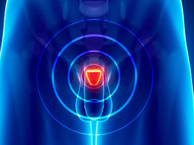 Νέα θεραπεία με λιγότερες παρενέργειες για την υπερπλασία του προστάτη