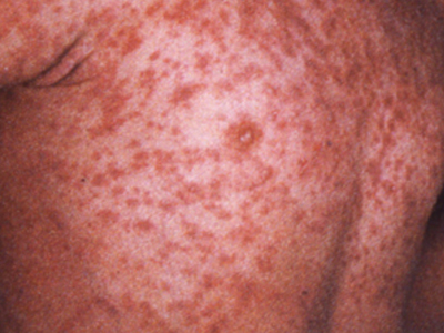 Τι είναι η ιλαρά