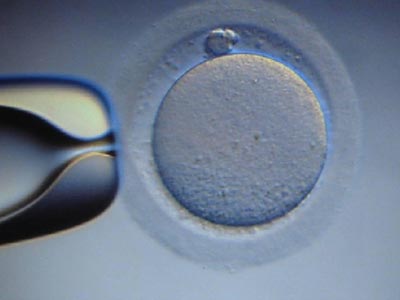 Η εξωσωματική γονιμοποίηση και η αγορά της ελπίδας