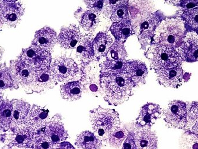 Ιοί ευθύνονται για το 40% των καρκίνων