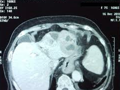 Καρκίνος ήπατος: Αιτίες, σημεία και συμπτώματα