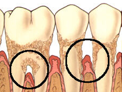 Τι είναι η περιοδοντίτιδα