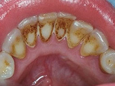 Τι είναι η πέτρα των δοντιών;