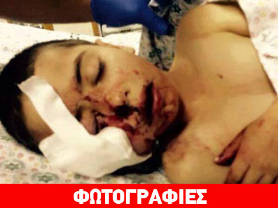 Πυροβόλησαν με πλαστική σφαίρα 5χρονο Παλαιστίνιο στο πρόσωπο