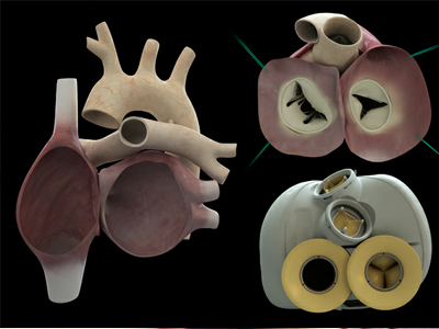 Πραγματικότητα η τεχνητή καρδιά