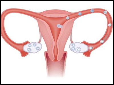 Ανακαλύφθηκε γονίδιο που οδηγεί στον καρκίνο των ωοθηκών