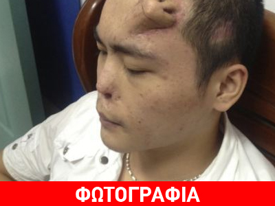 Δημιούργησαν μύτη στο… μέτωπο ασθενούς!