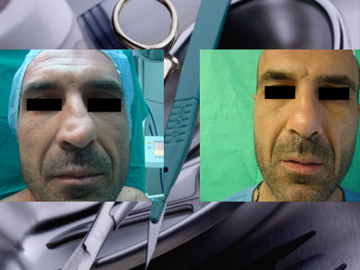 Επανορθωτική χειρουργική ρινός: Η πρόκληση