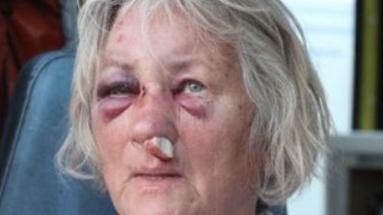 Tραυματισμένη τουρίστρια περιγράφει τον εφιάλτη της καταιγίδας στη Σκόπελο