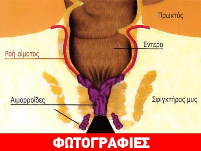 Αιμορροΐδες: Σύγχρονες θεραπείες για μια συνηθισμένη πάθηση