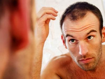 Η φαλάκρα ένδειξη αυξημένου κινδύνου για την καρδιά