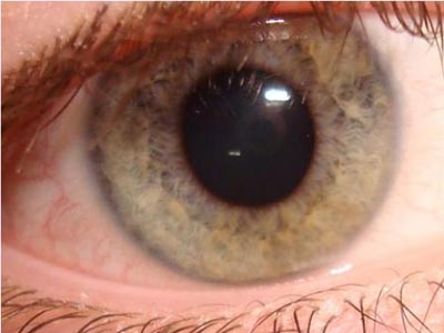 Έβγαλαν από το μάτι του ζωντανό σκουλήκι!