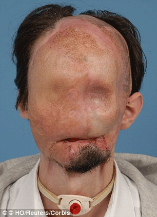 Πριν τη μεταμόσχευση