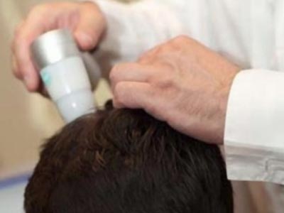 Οι νεότερες θεραπείες για την τριχόπτωση