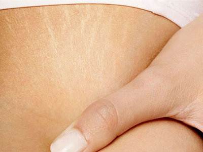 Πως θα εξαφανίσετε τις ραγάδες