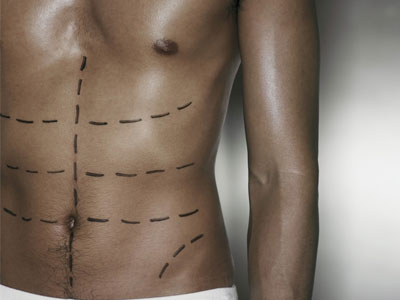 Η πλαστική χειρουργική βάζει τέλος στη γυναικομαστία Η πλαστική χειρουργική βάζει τέλος στη γυναικομαστία