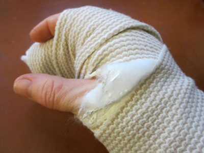 Πάτρα: Καταστηματάρχης έσπασε το χέρι του μετά από έλεγχο του ΙΚΑ