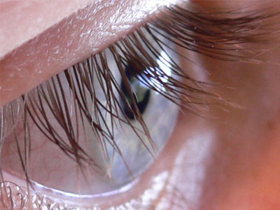 Βλεφαροπλαστική χωρίς νυστέρι Βλεφαροπλαστική χωρίς νυστέρι