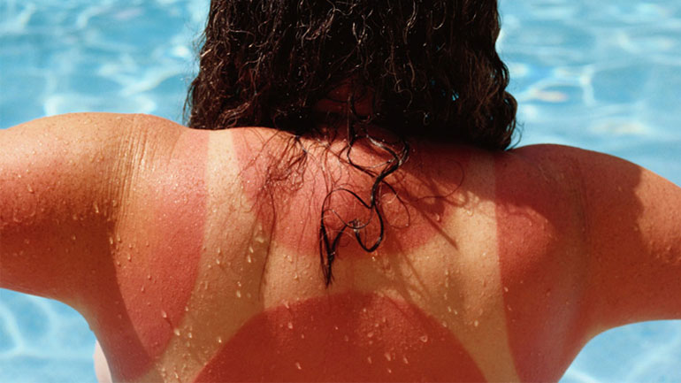 Η αντιμετώπιση του εγκαύματος από τον ήλιο