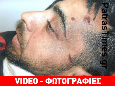 Πάτρα: Άγριος ξυλοδαρμός νεαρού από αστυνομικούς