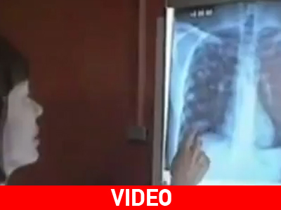 Ινδία: Κρούσματα ολικά ανθεκτικής φυματίωσης