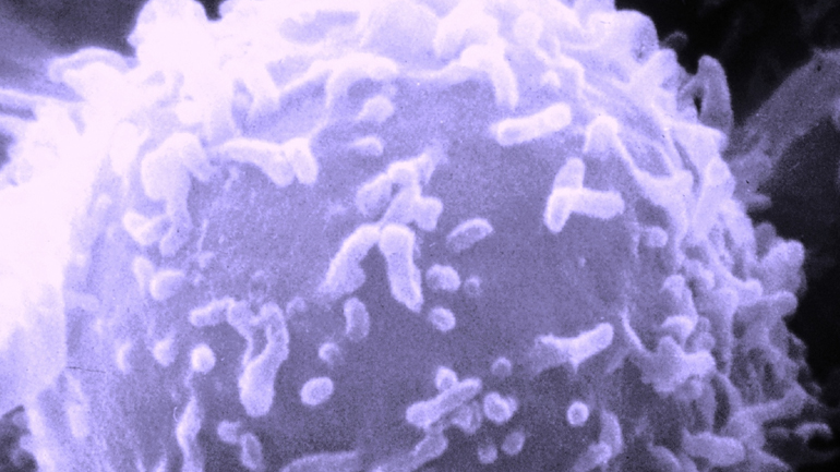 Η αυτοάνοση φλεγμονή του προστάτη και η ανδρική υπογονιμότητα Η αυτοάνοση φλεγμονή του προστάτη και η ανδρική υπογονιμότητα