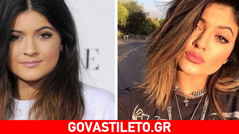 Kylie Jenner: Ξεπερνούν τα 40.000 δολάρια οι πλαστικές επεμβάσεις που έχει κάνει!