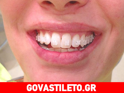 Ποια παρουσιάστρια έβαλε… σιδεράκια; Ποια παρουσιάστρια έβαλε… σιδεράκια;