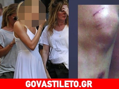 Ποια διάσημη καλλονή έχει αυτό το άσχημο τραύμα στο πόδι της;