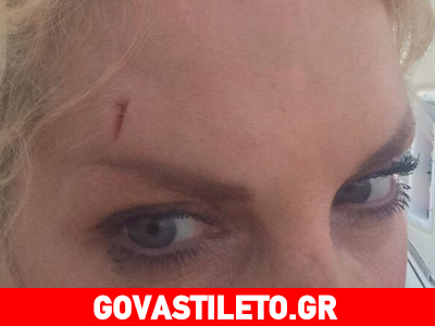 Τραυματίστηκε η Ελένη Μενεγάκη και έκανε ράμματα! Τραυματίστηκε η Ελένη Μενεγάκη και έκανε ράμματα!