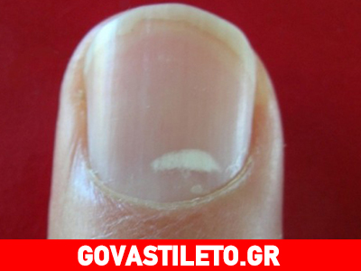 Μύθος ότι οι λευκές κηλίδες στα νύχια δείχνουν έλλειψη ασβεστίου