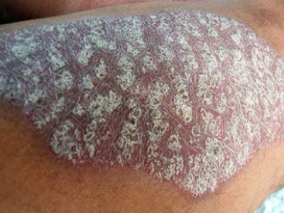 SEXUALITY: Ψωρίαση