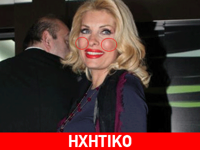 Τα… φουσκωμένα ζυγωματικά της Ελένης Μενεγάκη