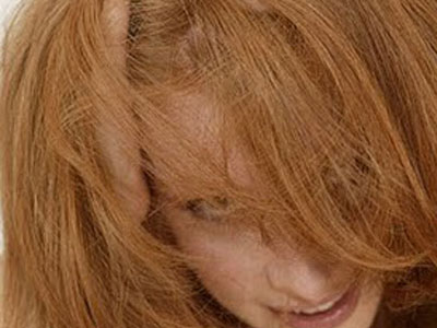 Η πιτυρίδα δεν κάνει διακρίσεις