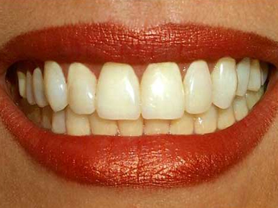 Κακοσμία του στόματος Κακοσμία του στόματος