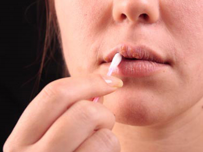 Χειλάκι πετροκέρασο