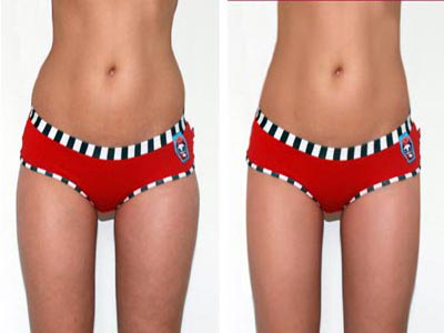 SlimLipo: Λιποαναρρόφηση με laser