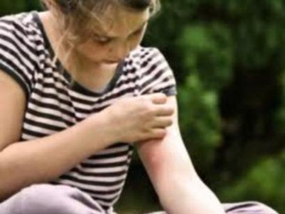 Πώς εξαφανίζονται τα σημάδια από τα κουνούπια;