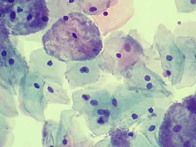 Προσοχή στο βακτήριο Gardenella Vaginalis