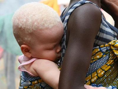 Τανζανία: Δολοφόνησαν και ακρωτηρίασαν μωρό αλμπίνο