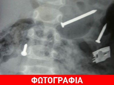 Πάτρα: Άνδρας είχε καταπιεί… ρολόι, κοσμήματα και βίδες!