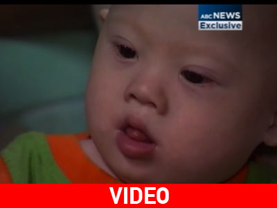 Ταϊλάνδη: Παρένθετη μητέρα αναλαμβάνει μωρό με σύνδρομο Down